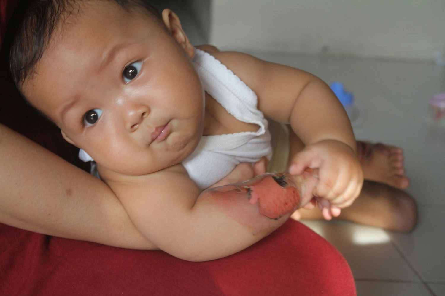 Adorable baby boy has burns surrounded by scabs and exudate on hands and feet of baby
